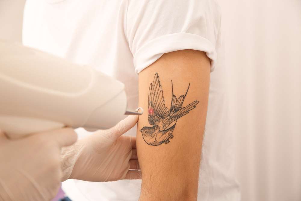 Tattoo Removal In Moti Nagar