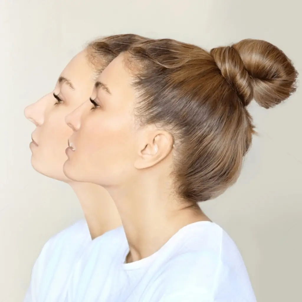 Chin augmentation in rohini