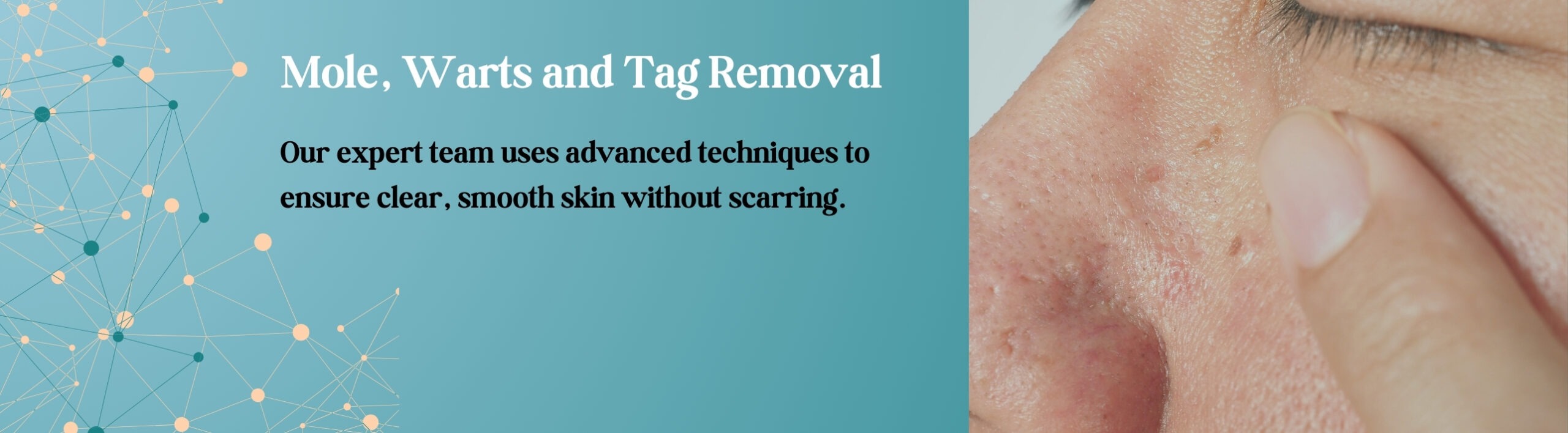 mole warts & tag removal