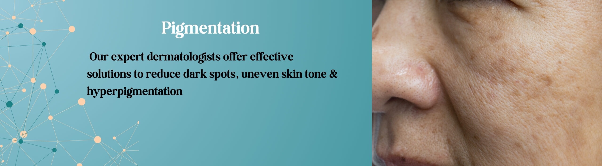 Pigmentation tretament in west delhi