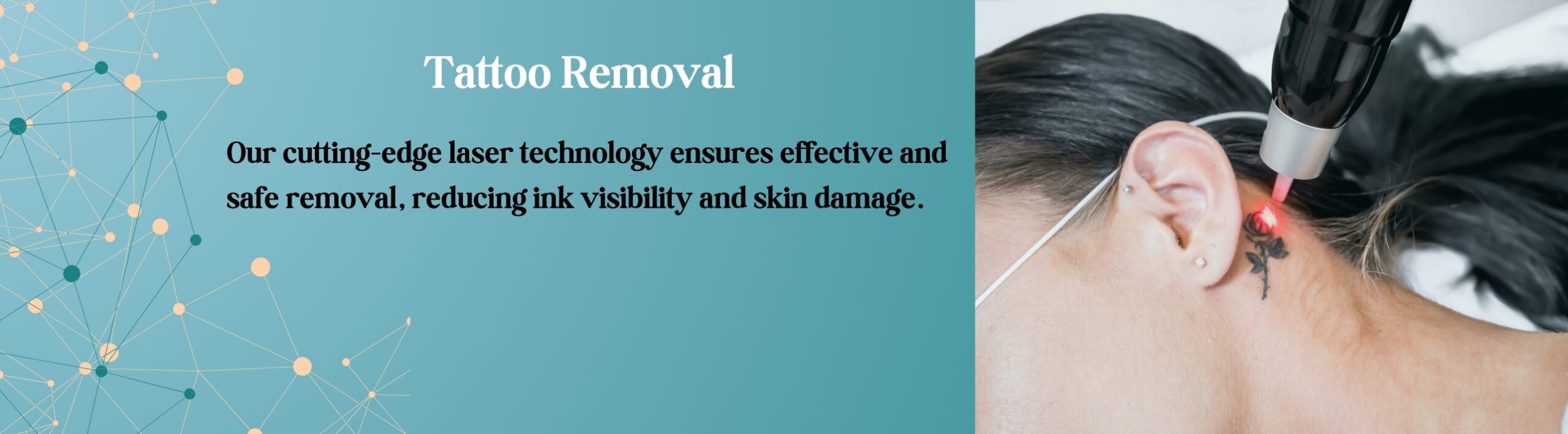 Tattoo Removal in moti nagar