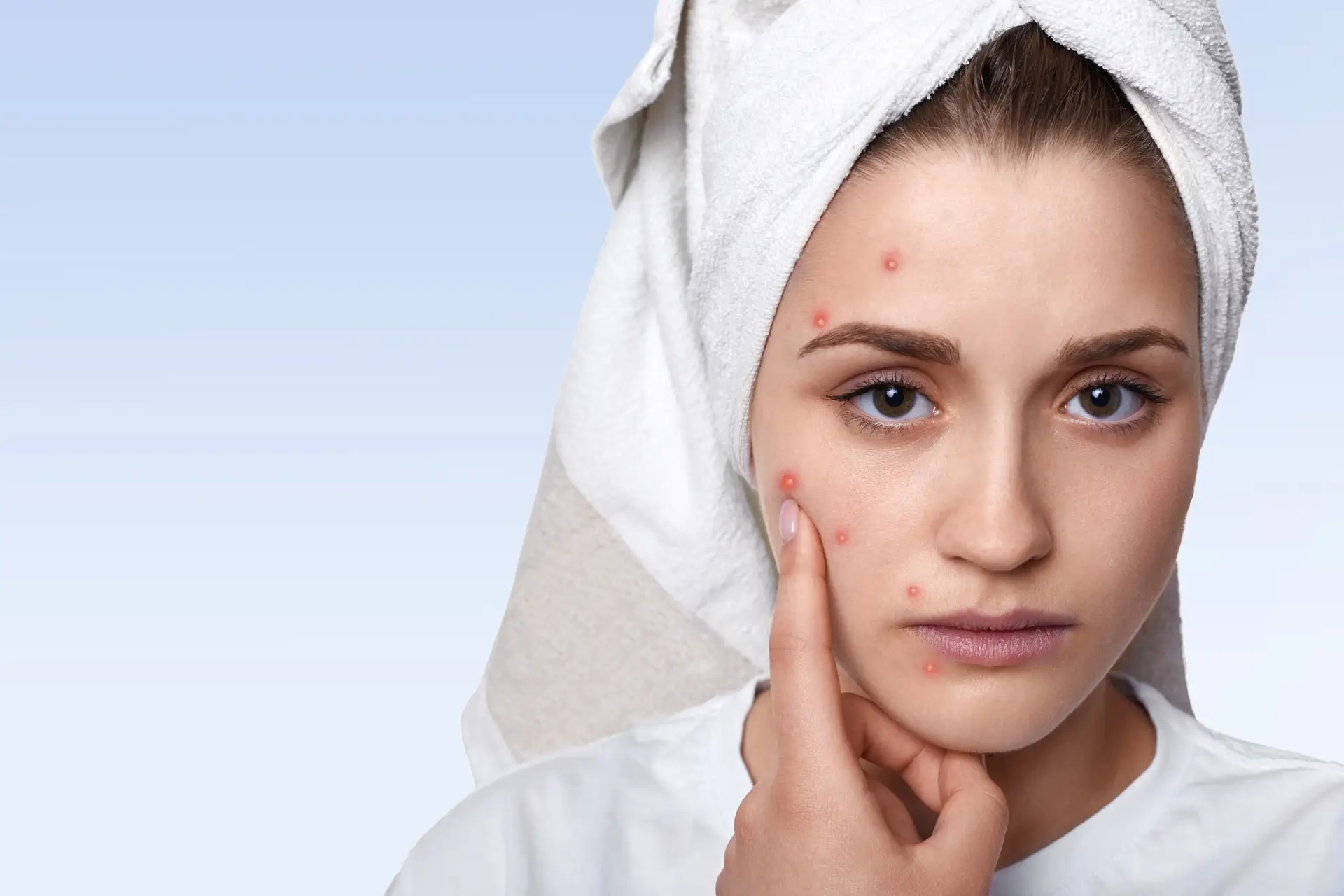 Acne Treatment in Delhi NCR