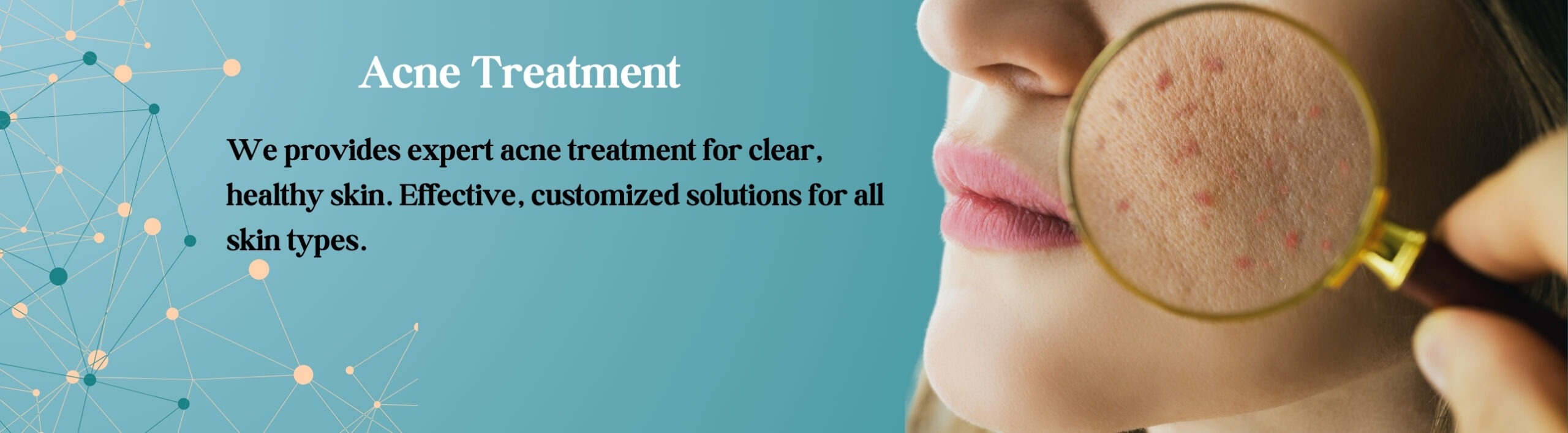 Acne Treatment in Moti Nagar